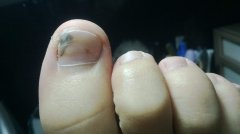 怎樣治療灰指甲？